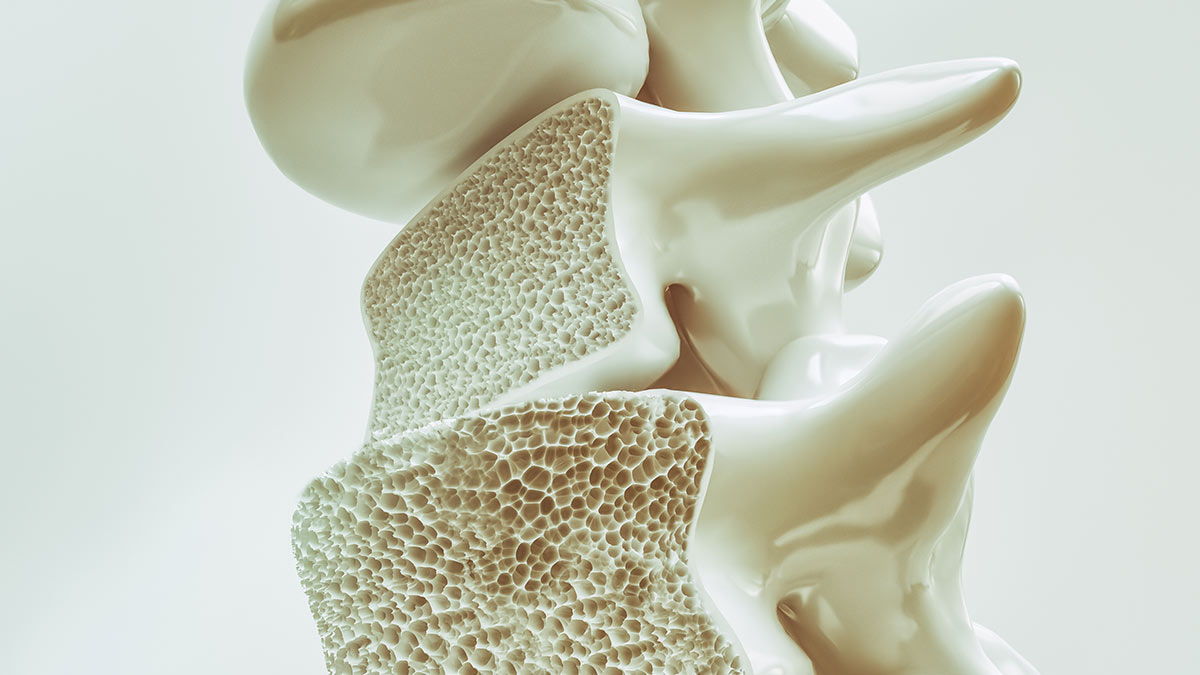 osteoporosis management