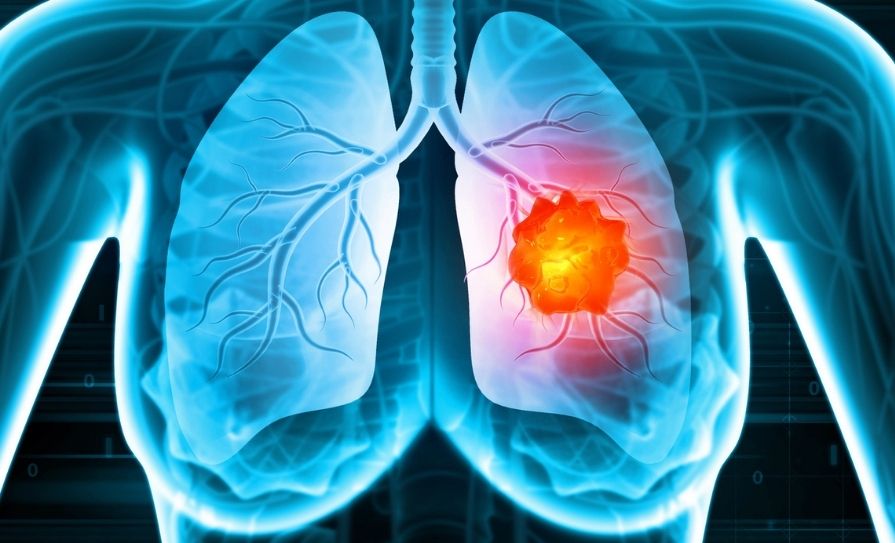 lung cancer