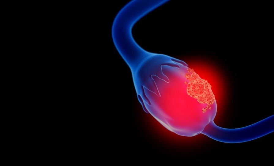 ovarian cancer